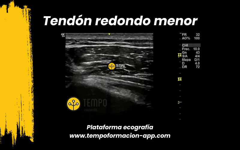 11. Ecografia tempo formacion manguito rotador tendon supraespinoso infraespinoso redondo menor subescapular.png